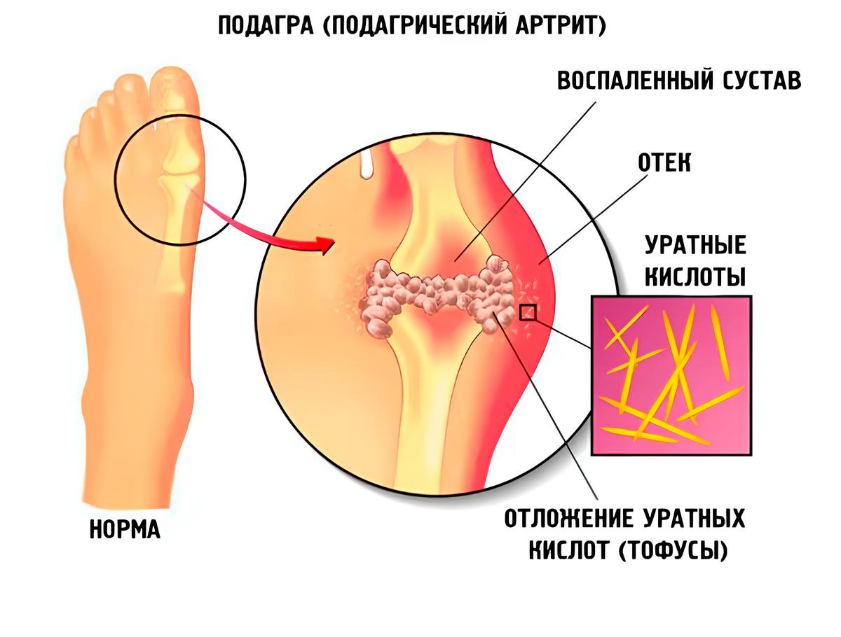 podagra
