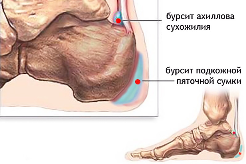 Симптомы бурсита