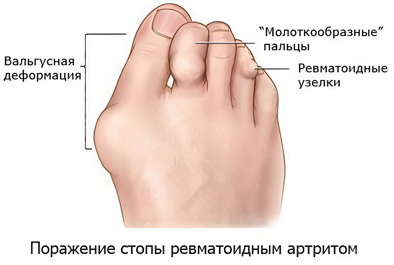 Ревматоидный артрит на стопах