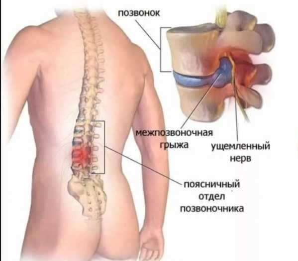 строение здорового позвоночника и с грыжей