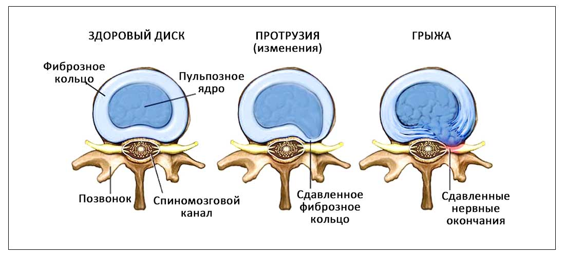 здоровый диск, протрузия и грыжа диска