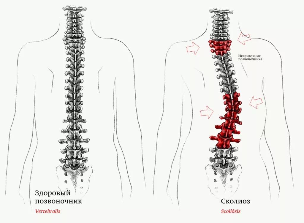 Симптомы сколиоза