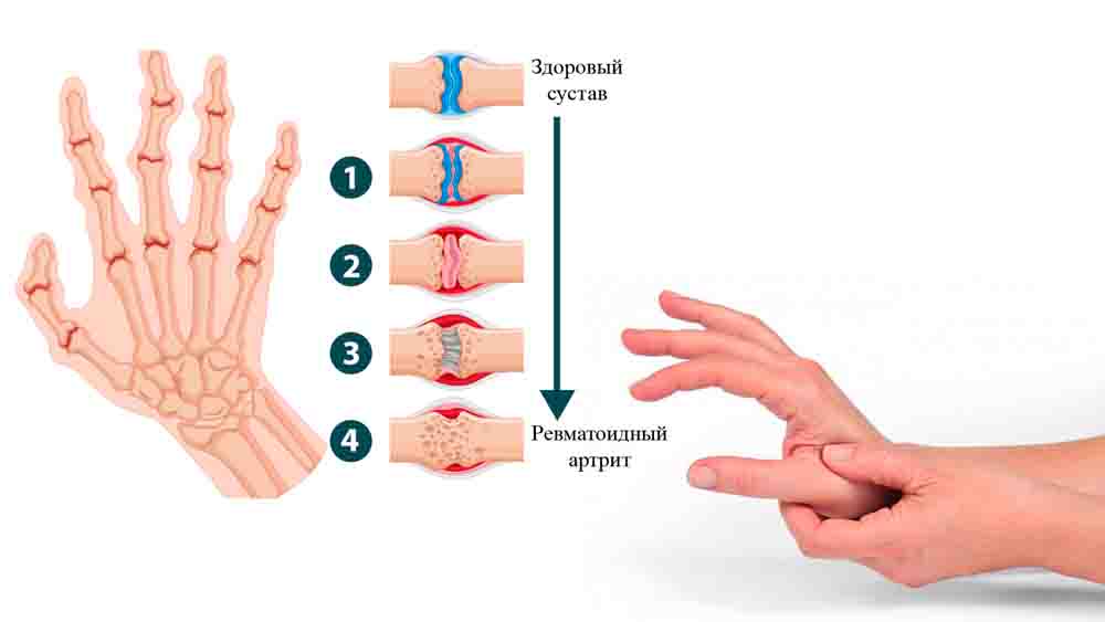  Симптомы ревматоидного артрита